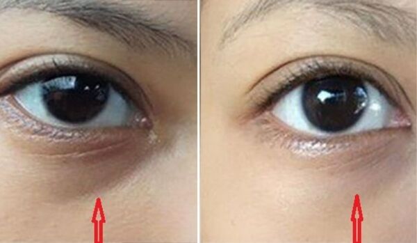 Mách bạn những cách hết thâm mắt hiệu quả tại nhà