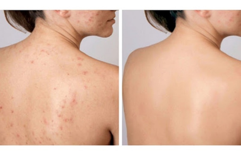 Bật mí cách trị mụn lưng tại hiệu quả, không gây thâm mụn