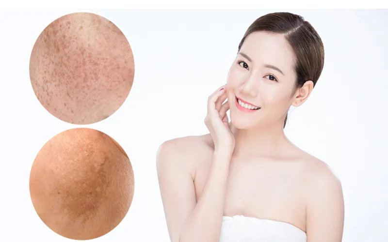 Hướng dẫn chăm sóc da nám giúp da sáng mịn và đều màu